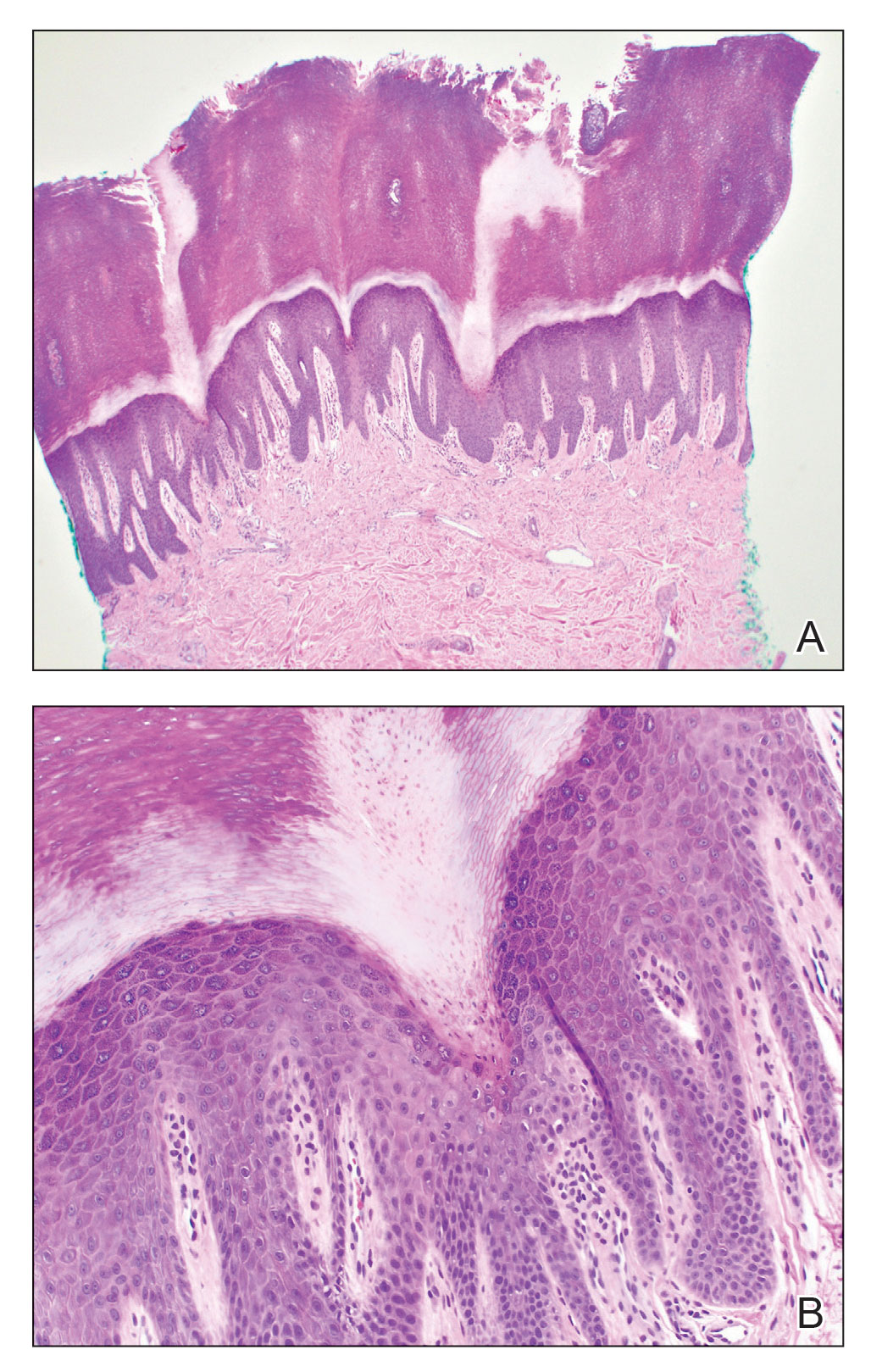 Histopathology showed incipient cornoid lamellae formation, pigment incontinence, and sparse dermal lymphocytic inflammation, suggestive of porokeratosis