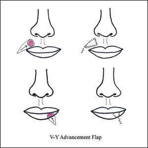 Illustrations of flaps for lip reconstruction.