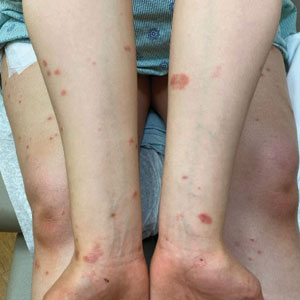 Pemphigoid gestationis with urticarial plaques on the forearms and wrists in a pregnant woman at 37 weeks’ gestation following vaccination for COVID-19 with a messenger RNA vaccine.