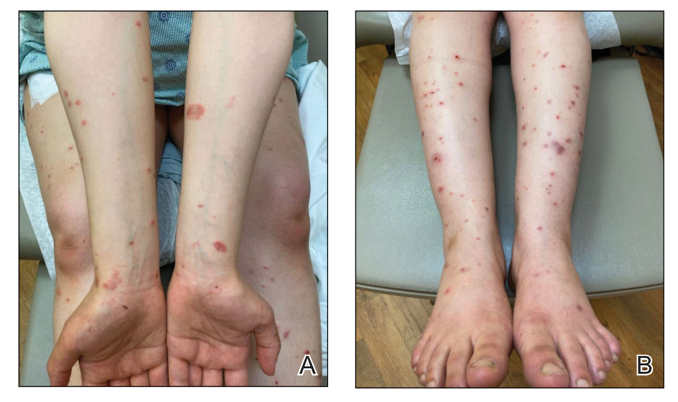 A, Pemphigoid gestationis with urticarial plaques on the forearms and wrists in a pregnant woman at 37 weeks’ gestation following vaccination for COVID-19 with a messenger RNA vaccine. B, Excoriated and erythematous papules developed on the legs.