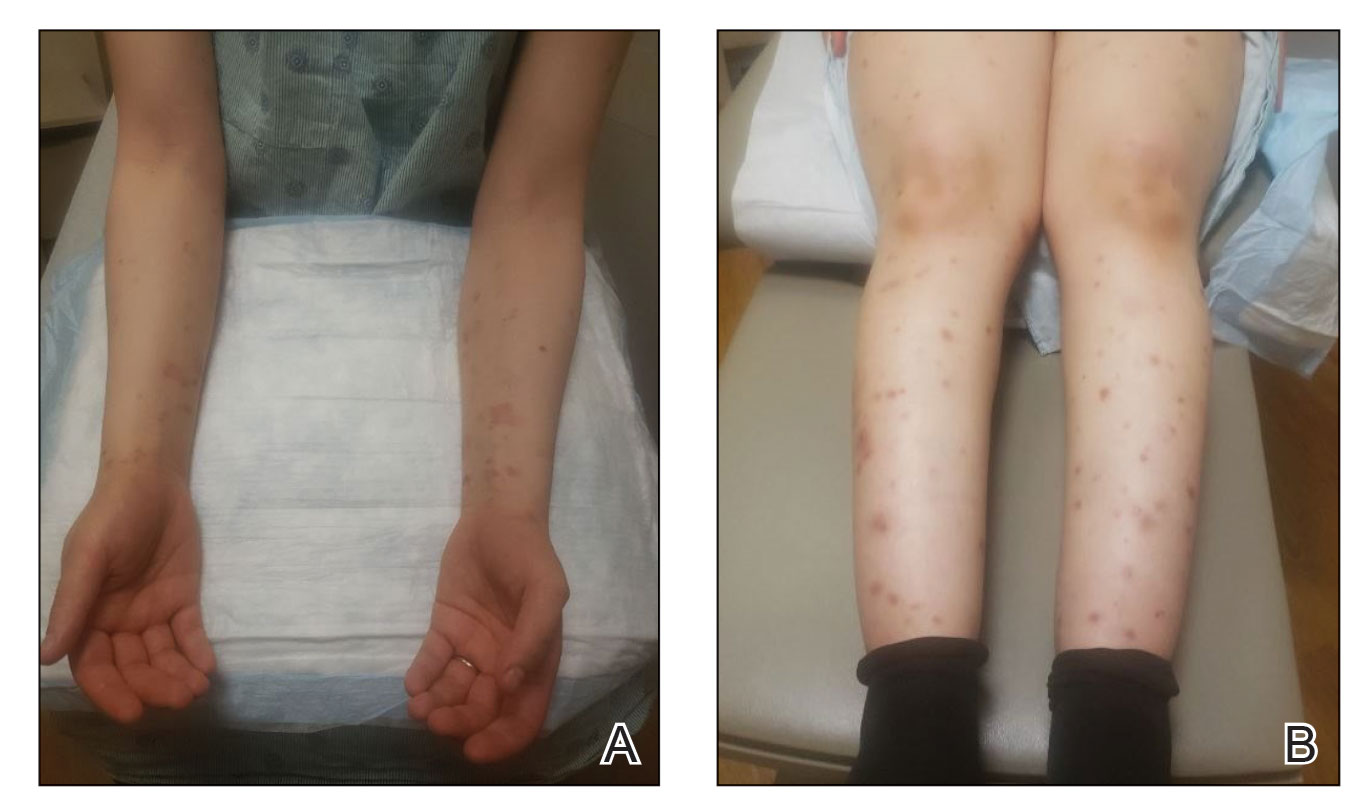 Two months post partum, postinflammatory hyperpigmentation was present on the forearms and wrists while erythematous papules persisted on the legs, respectively.