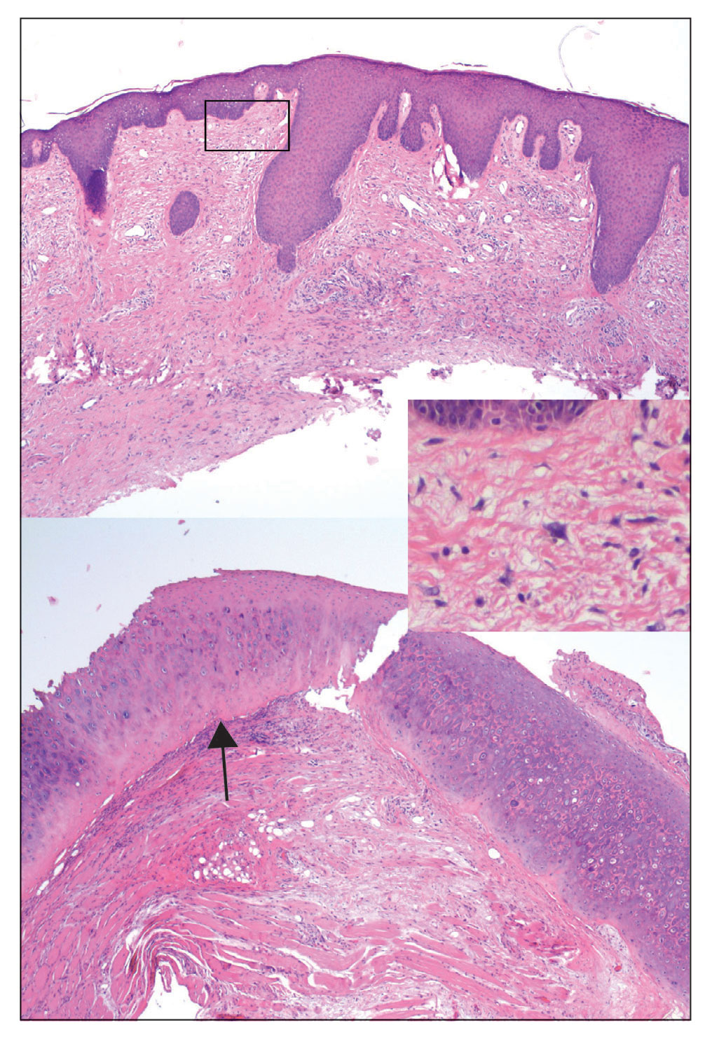 Top, Histopathology of a tangential biopsy revealed an acantholytic epidermis with dermal inflammation (H&E, original magnification ×40). Bottom, Higher-power view showed degenerated cartilage (arrow) consistent with chondrodermatitis nodularis helicis