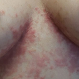 Papular reticulated rash