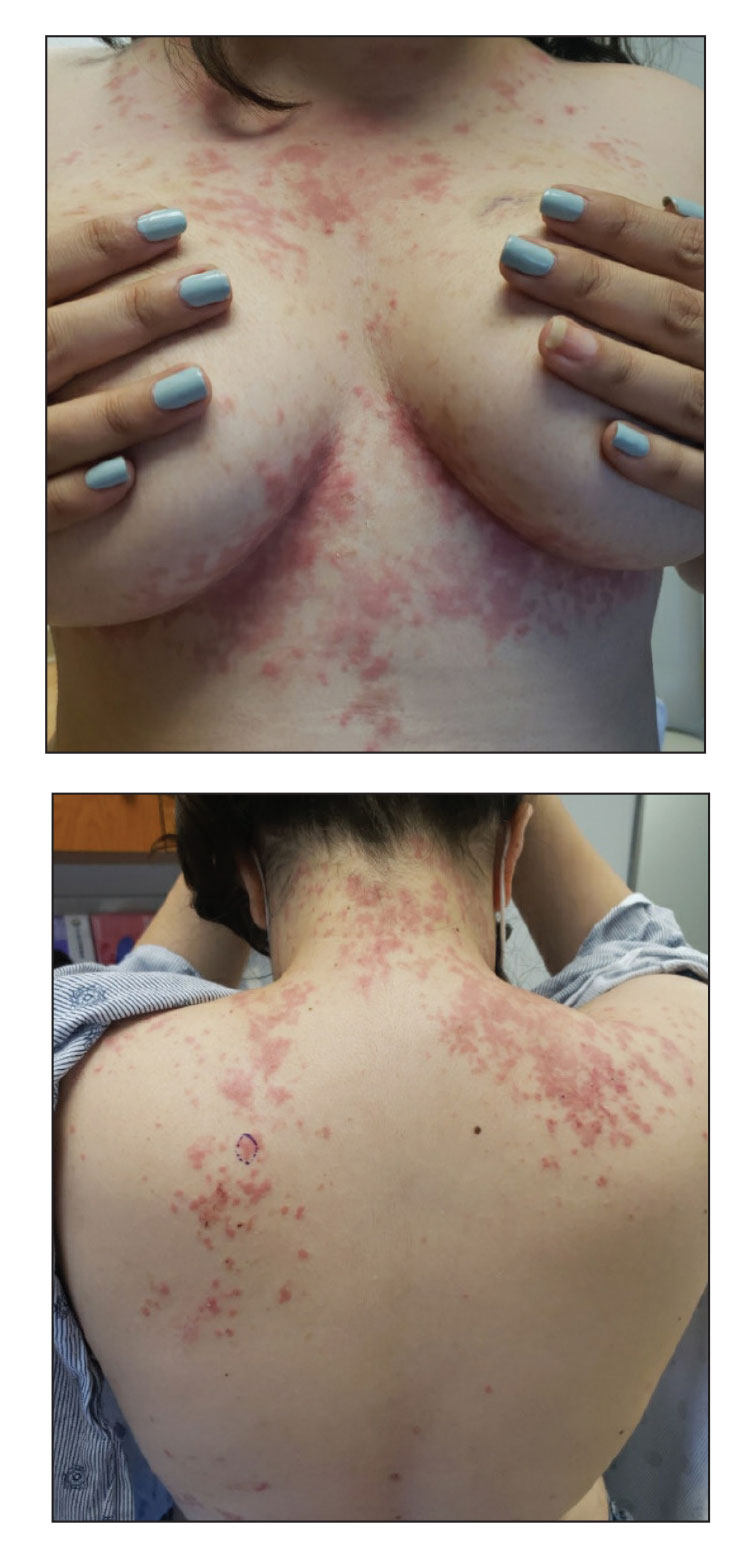 Papular reticulated rash