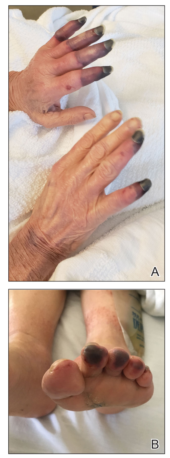 Acral necrosis after immune checkpoint inhibitor therapy. A, Purpura and necrosis were present on the fingers. B, Purpuric papules and necrosis were seen on the toe pads.