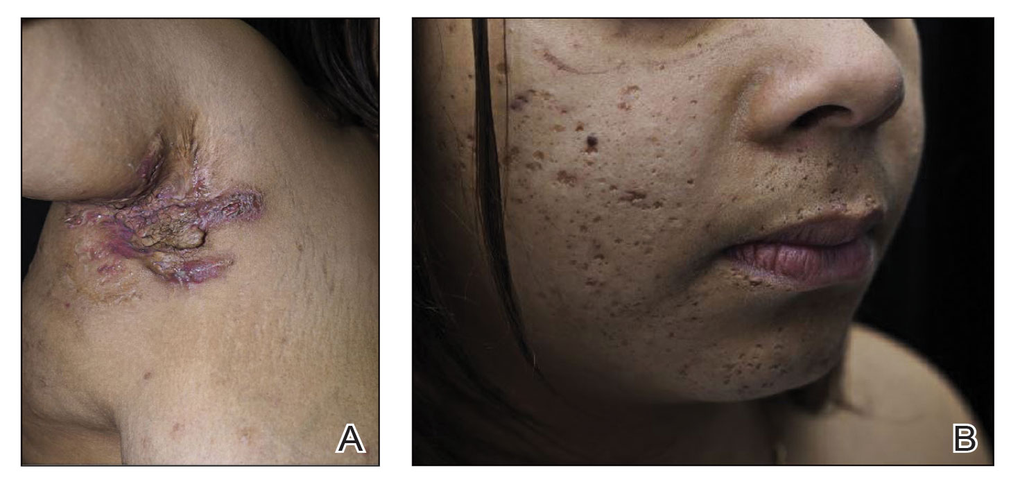 A, Erythematous and violaceous plaques with scarring sinus tracts and ulceration on the right axilla. B, Nodulocystic acne with prominent ice pick and boxcar scarring on the face.