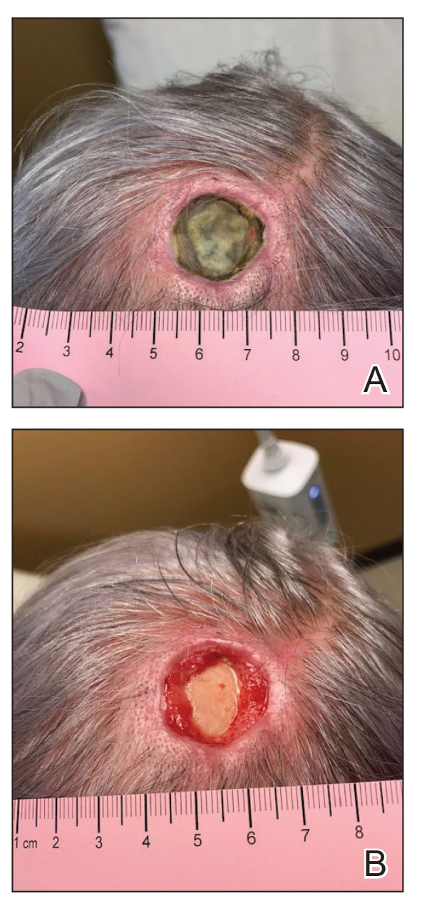 A, Initial presentation of a chronic wound with dehiscence on the scalp following Mohs micrographic surgery. B, The wound was debrided.