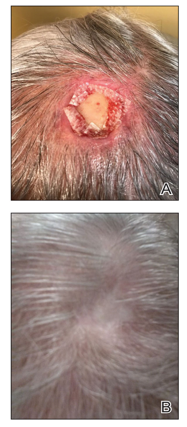 A, An extracellular matrix–based collagen dressing (Endoform Natural Restorative Bioscaffold [Aroa Biosurgery Inc]) was applied to the wound. B, The wound showed minimal scarring 3 years after closure.