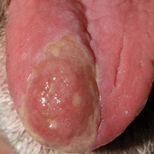 Papular acneform eruption with mucositis