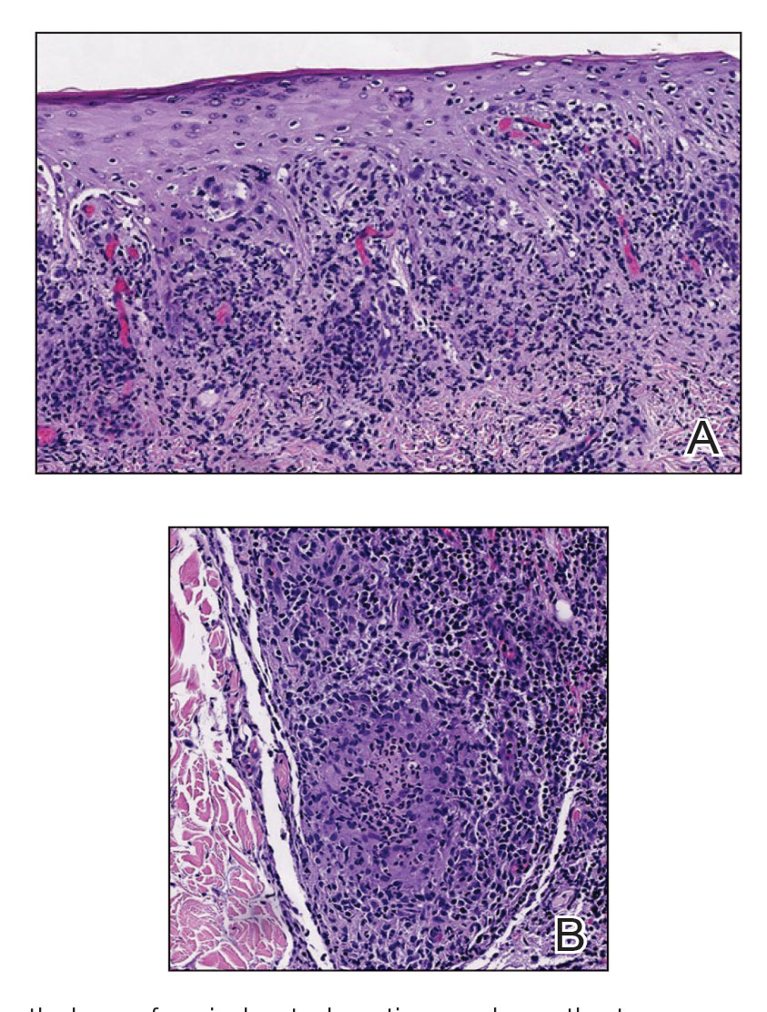 Histopathology of an indurated cystic papule on the torso