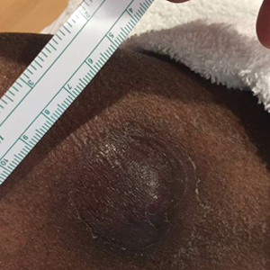 A brown, indurated, dome-shaped plaque on the inferomedial right thigh. No erythema, warmth, or fluctuance was present.