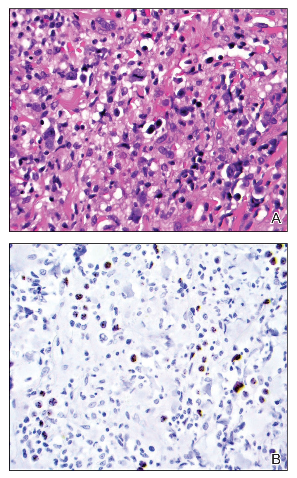 A, A punch biopsy demonstrated lymphoid aggregates and scattered large cells with plasmablastic morphology (H&E, original magnification ×400). B, Stippled staining of scattered large cells also was noted (HHV-8, original magnification ×400).