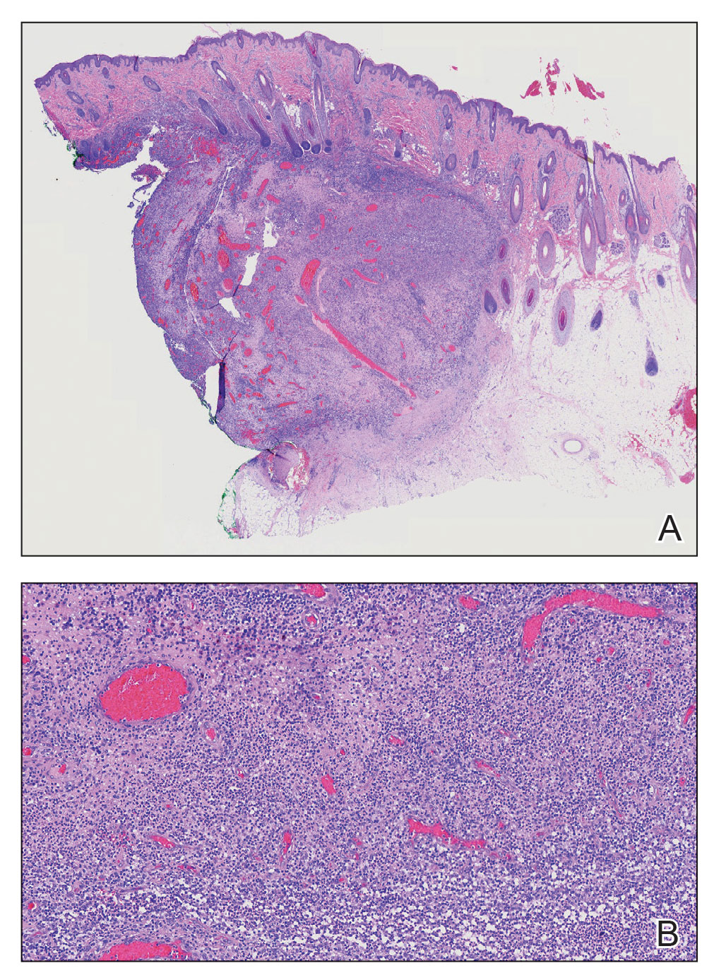 A, Histopathology revealed a relatively well-demarcated zone of deep dermal mixed inflammation with associated dilated vasculature with no true cyst or neoplasm (H&E, original magnification ×20). B, Admixed acute and granulomatous inflammation was present