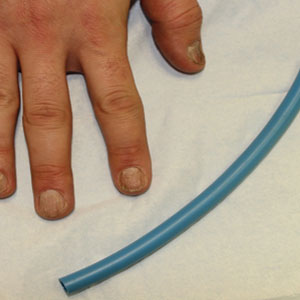 Trachyonychia of the fingernails on the right hand was being treated with painful intralesional triamcinolone injections to the nail matrix, and the patient brought in polyurethane tubing to help with pain management.