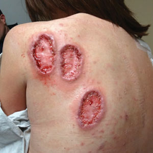 Pyoderma gangrenosum