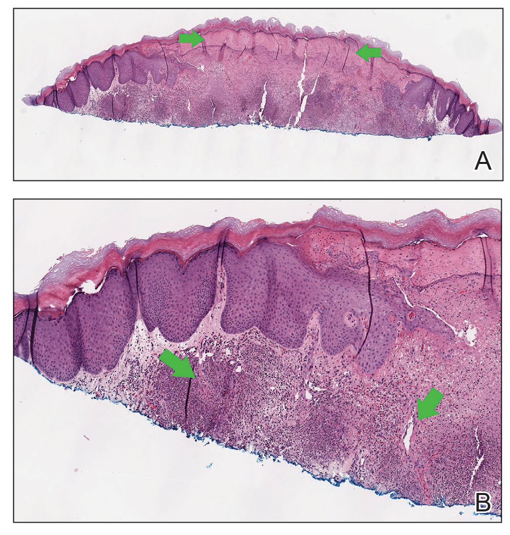 A, Histopathology of a skin lesion from the hand demonstrated an acral papule with central epidermal necrosis (between green arrows) and dense underlying inflammation. Neutrophils with associated karyorrhectic debris and eosinophils were seen