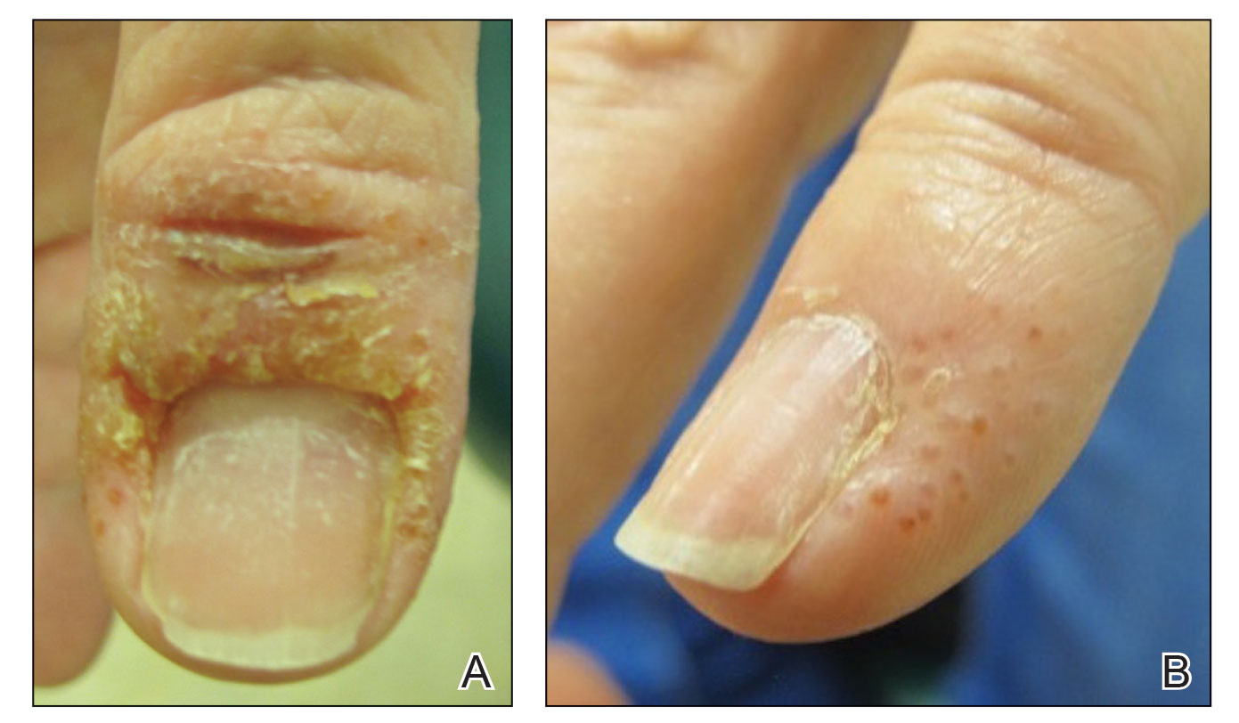 Chemical sealing of proximal nail fold with cyanoacrylate glue for  accelerated regeneration of nail cuticle as a treatment of chronic  paronychia - Cosmoderma