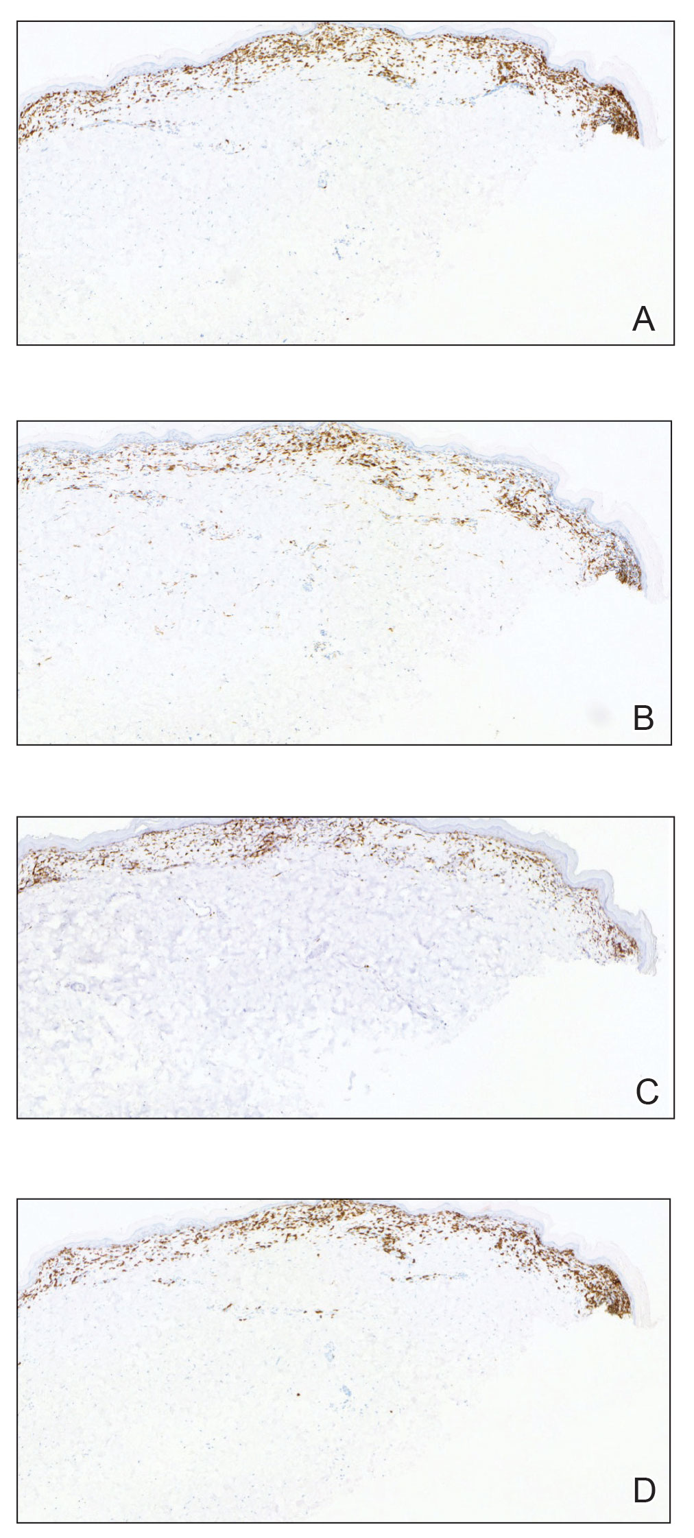 Immunohistochemical staining of atypical lymphocytes demonstrated the presence of CD3, CD8, and CD5, as well as the absence of CD4, respectively (original magnifications ×40).