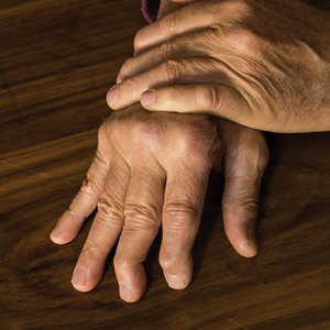 Psoriatic arthritis