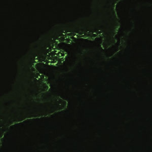 Mouse monoclonal antibodies to type VII collagen followed by goat anti-mouse IgG–fluorescein isothiocyanate conjugate (original magnification ×200).