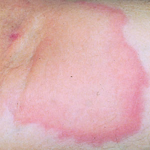 A well-circumscribed wheal with erythematous serpiginous borders and central punctum, secondary to a bite by a Triatoma bug.