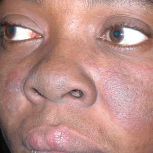 A Black woman with malar erythema and hyperpigmentation from acute cutaneous lupus erythematosus. The nasolabial folds are spared