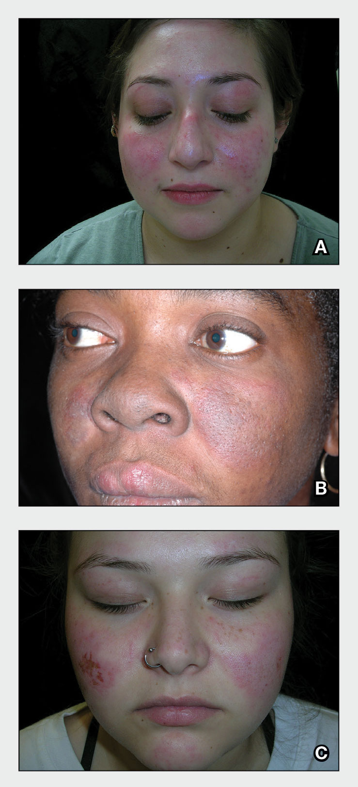 A 23-year-old White woman with malar erythema from acute cutaneous lupus erythematosus. The erythema also can be seen on the nose and eyelids but spares the nasolabial folds.