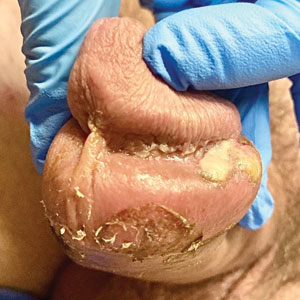 Genital ulcerations with swelling