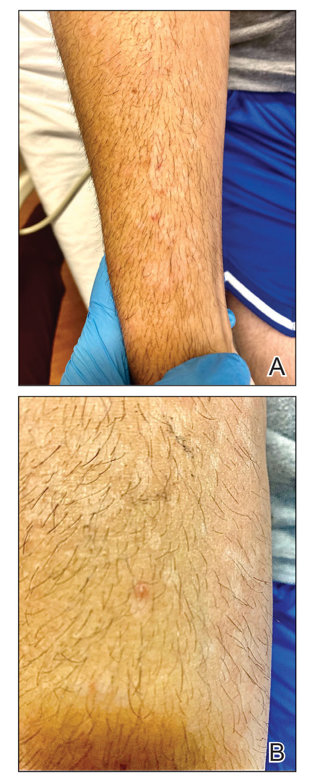 Erythematous papulopustules of mpox (monkeypox) on the arms.