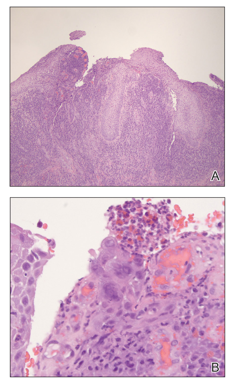 A, Histopathology revealed pseudoepitheliomatous epidermal hyperplasia with ulceration and a dense mixed inflammatory infiltrate (H&E, original magnification ×4).