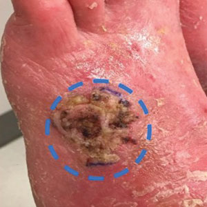 A cutaneous squamous cell carcinoma (cSCC) on the dorsal aspect of the left foot at presentation. Margins are inked and highlighted with a dashed circle.