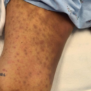 Hyperpigmented macules that coalesced into indurated plaques on the thighs