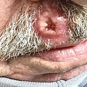 Ulcerated nodule on the lip