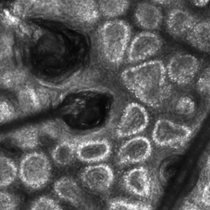 Distinguishable structures on reflectance confocal microscopy (RCM) images include individual keratinocytes, melanocytes, inflammatory cells, hair follicles, blood vessels, fibroblasts, and collagen.