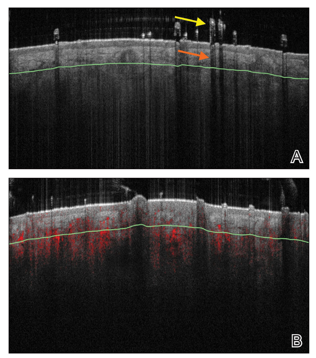 A, Optical coherence tomography (OCT) shows outlines of hair shafts above the epidermis (yellow arrow) in addition to the shaft’s shadow cast below the skin surface (orange arrow). B, Dynamic OCT imaging of the scalp shows vascular flow below the skin’s