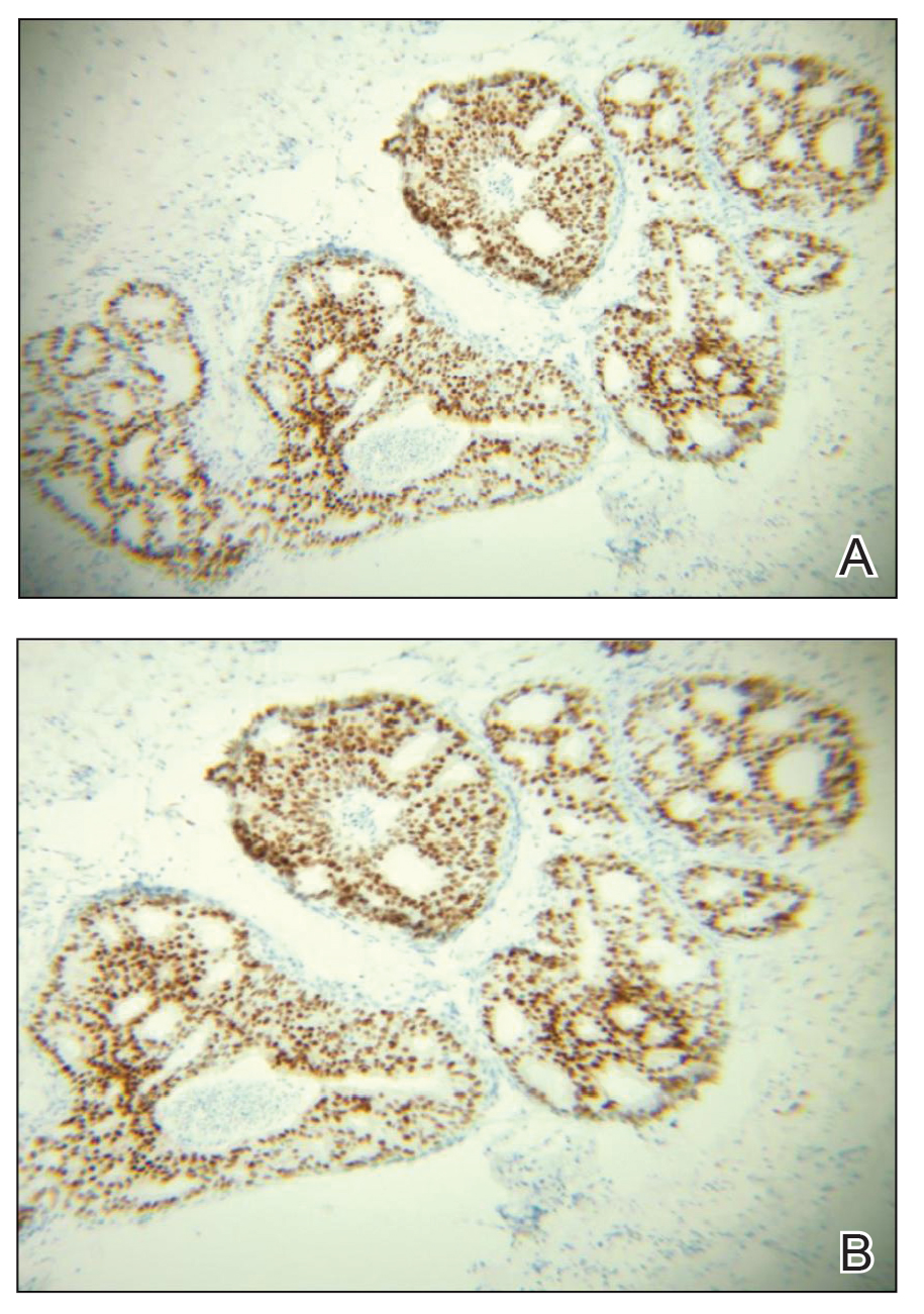 Immunostaining showed positive expressions of estrogen and progesterone receptors, respectively (original magnifications ×100).