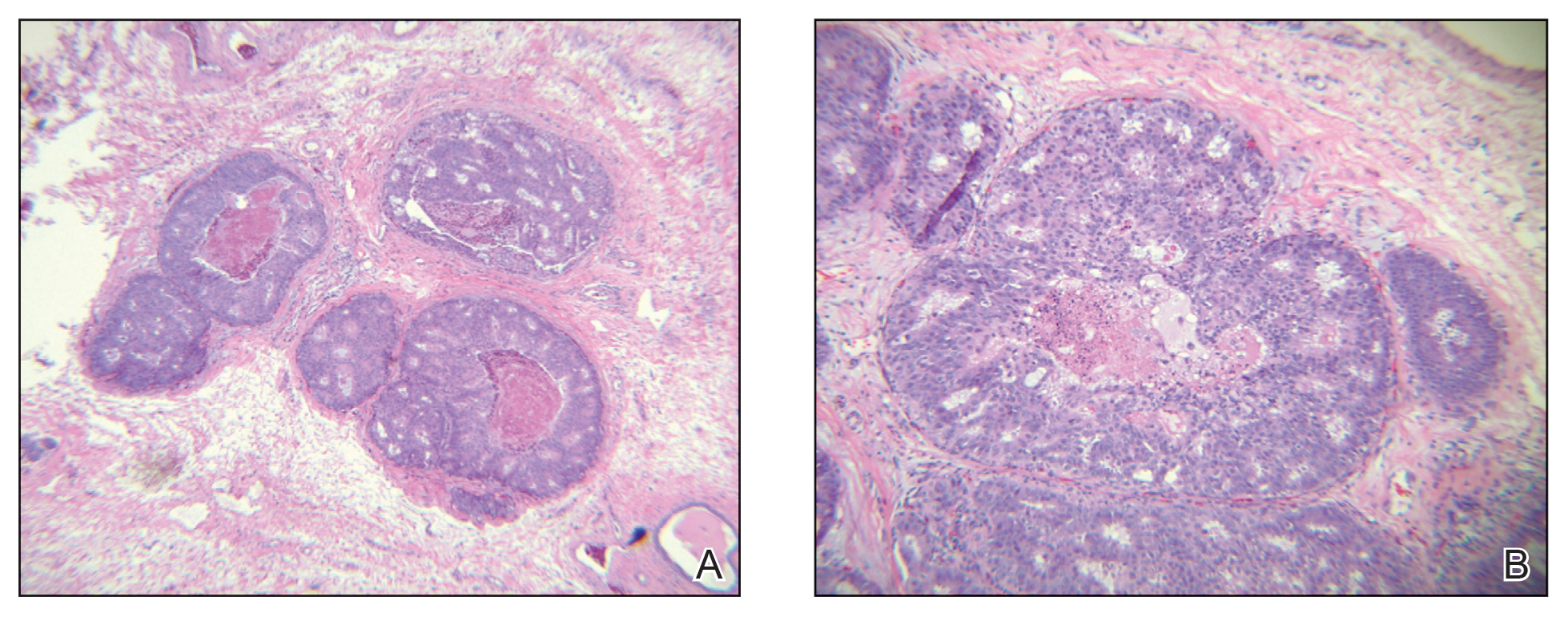 Histopathology revealed central expansile necrosis containing cellular debris, which generally is associated with high-grade ductal carcinoma in situ.