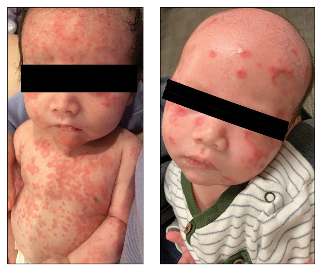 Diffuse annular plaques in an infant