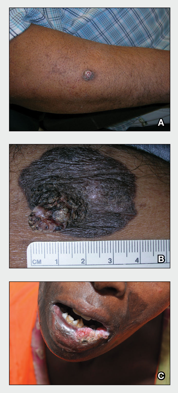 A A 51-year-old Hispanic man with a squamous cell carcinoma (SCC) of the keratoacanthoma type on the arm.