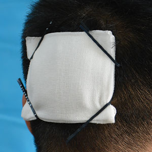 Use of hairpins to tightly affix a dressing to a scalp wound in a patient with short hair.