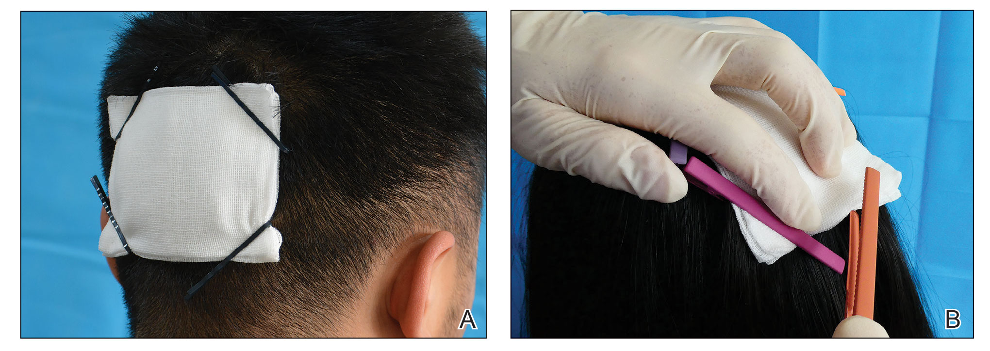 A, Use of hairpins to tightly affix a dressing to a scalp wound in a patient with short hair. B, Hairpins are smoothly removed.