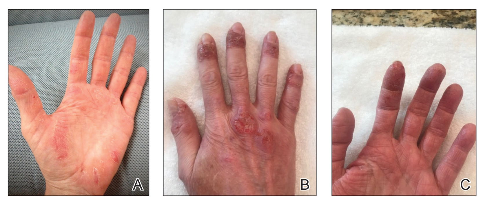 Erythematous scaly plaques on the palms and dorsal hands 1 year after starting guselkumab therapy.