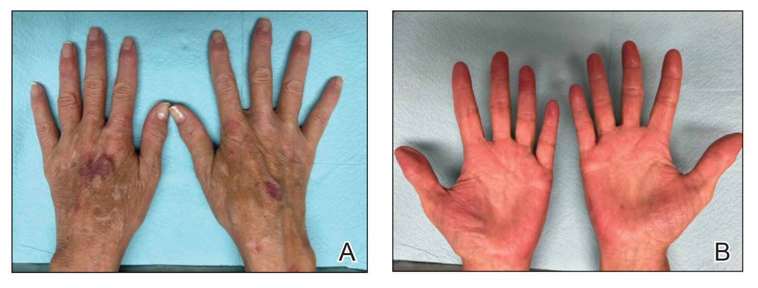 Nearcomplete resolution of symptoms approximately 1 year after dual biologic treatment with guselkumab and dupilumab was initiated.