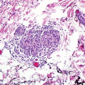 Nonnecrotizing granuloma with scant surrounding lymphocytes was present (H&E, original magnification ×200).