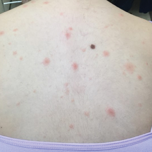 Multiple pink papules with central scale were present on the upper back.