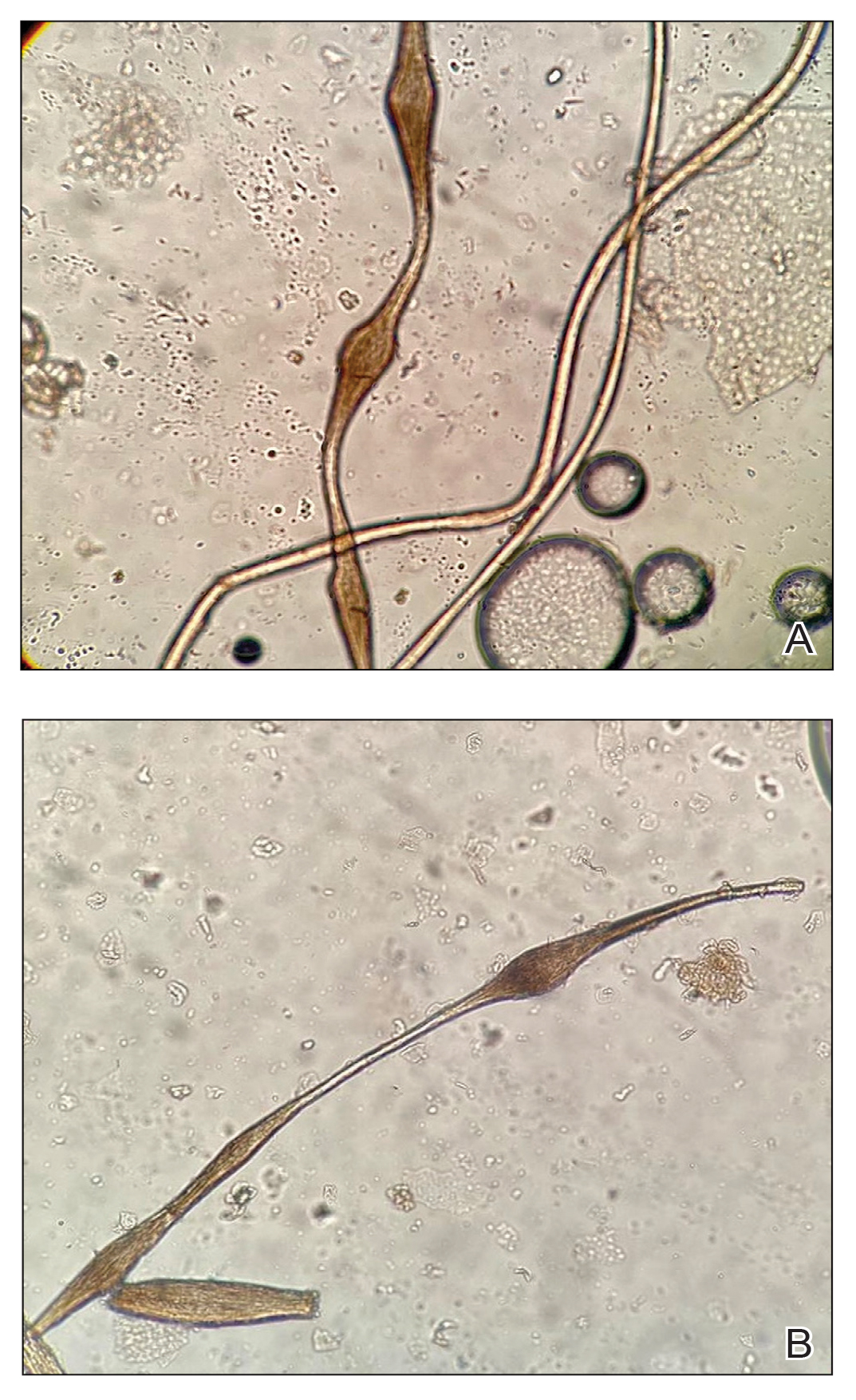 Optical microscopy showed uniform elliptical nodes separated by intermittent constrictions and broken hair shafts at internode levels, respectively (original magnifications ×100).