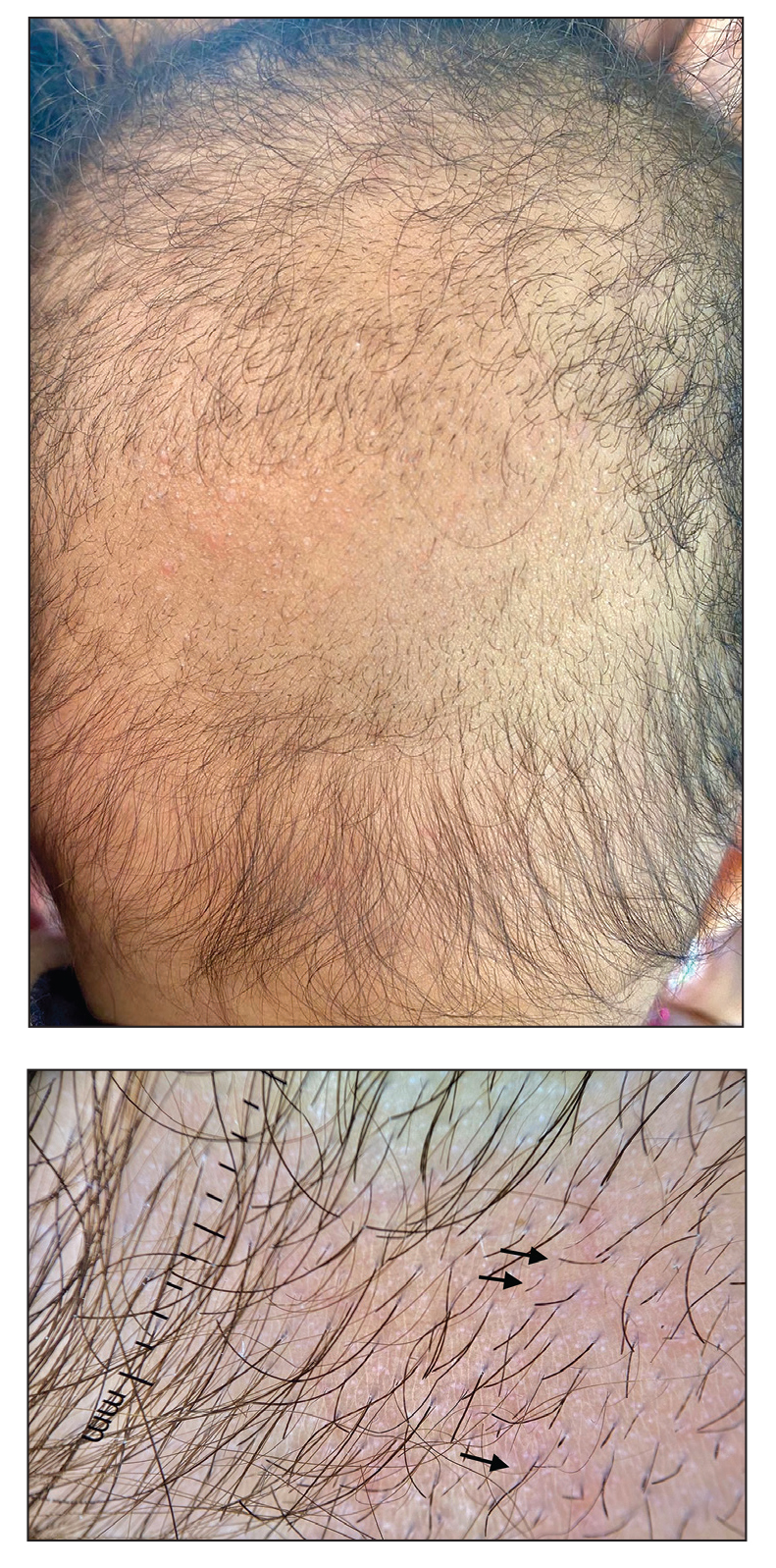 Hypotrichosis and hair loss on the occipital scalp