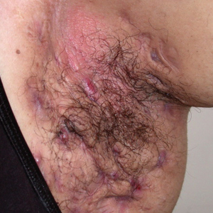 Hidradenitis suppurativa