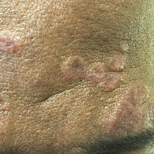 Erythematous to violaceous, flat papules and small plaques with some scaling across the forehead in a patient with sarcoidosis.