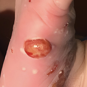 Disseminated papules and nodules on the skin and oral mucosa in an infant